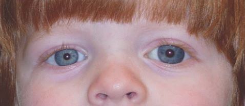 Glaucoma en Niños