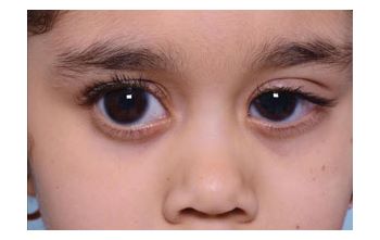Glaucoma en Niños