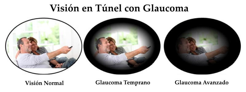 Visión en Túnel del Glaucoma