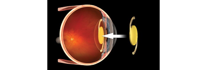 Implante lente intraocular