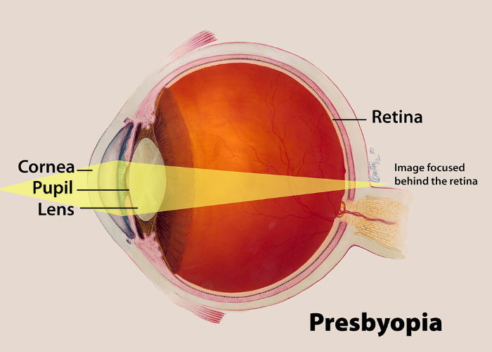 Anatomía del ojo con Presbicia
